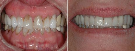 Upper Porcelain Veneers