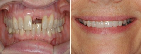 Veneers and Implant Crown