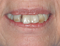 Complete Upper Denture